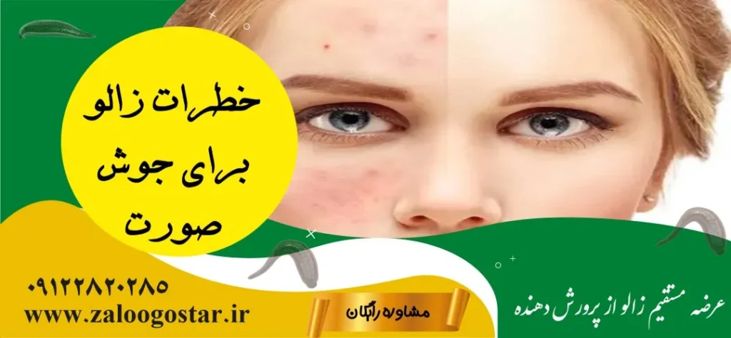 زالو برای جوش صورت