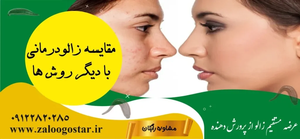 زالو برای جوش صورت