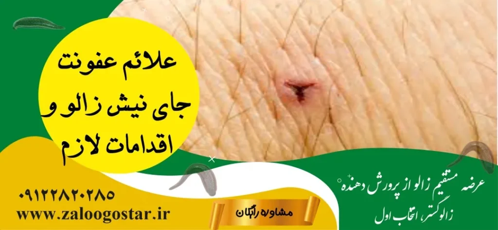 جای زالو کی خوب میشه