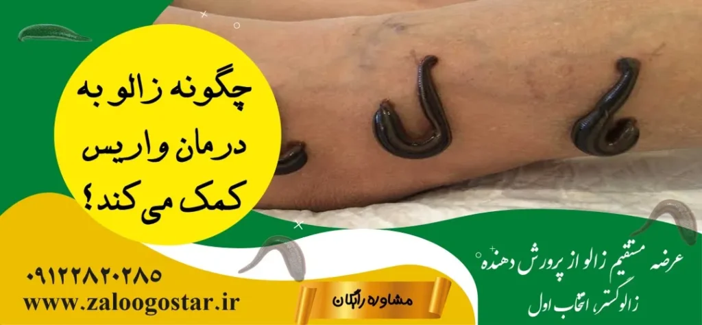 خرید زالو برای واریس پا