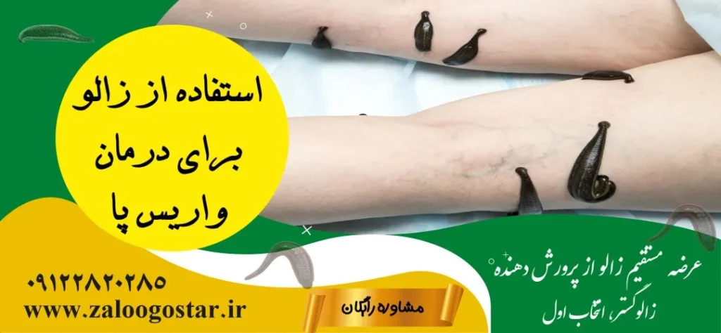 خرید زالو برای واریس پا