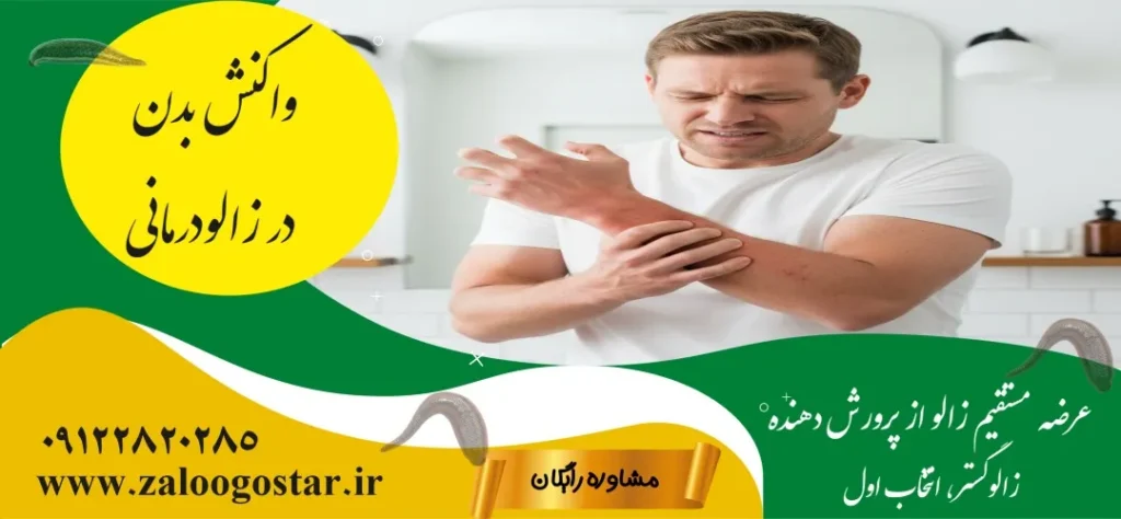 زالو درمانی در خانه