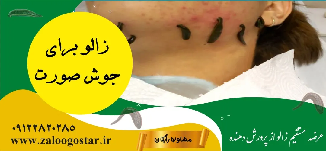 زالو برای جوش صورت