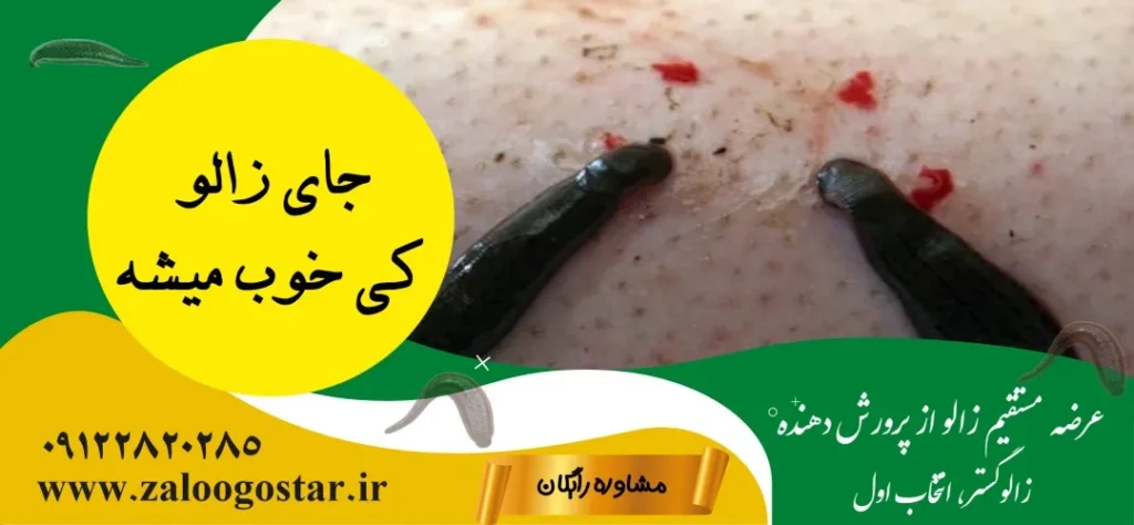 جای زالو کی خوب میشه
